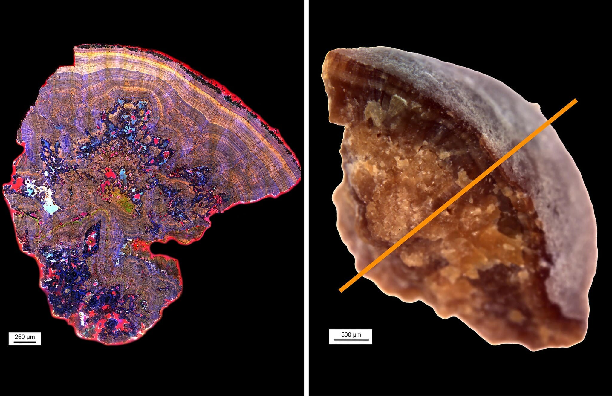 new research in kidney stones