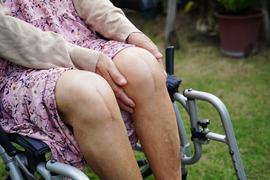 A woman in a wheelchair after having knee surgery