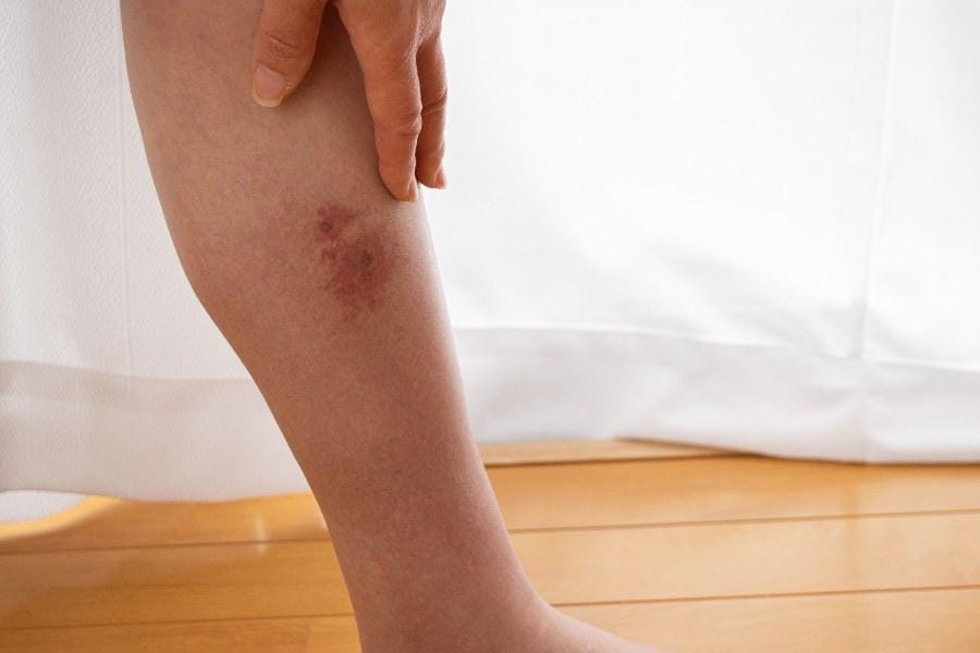 common cellulitis symptoms