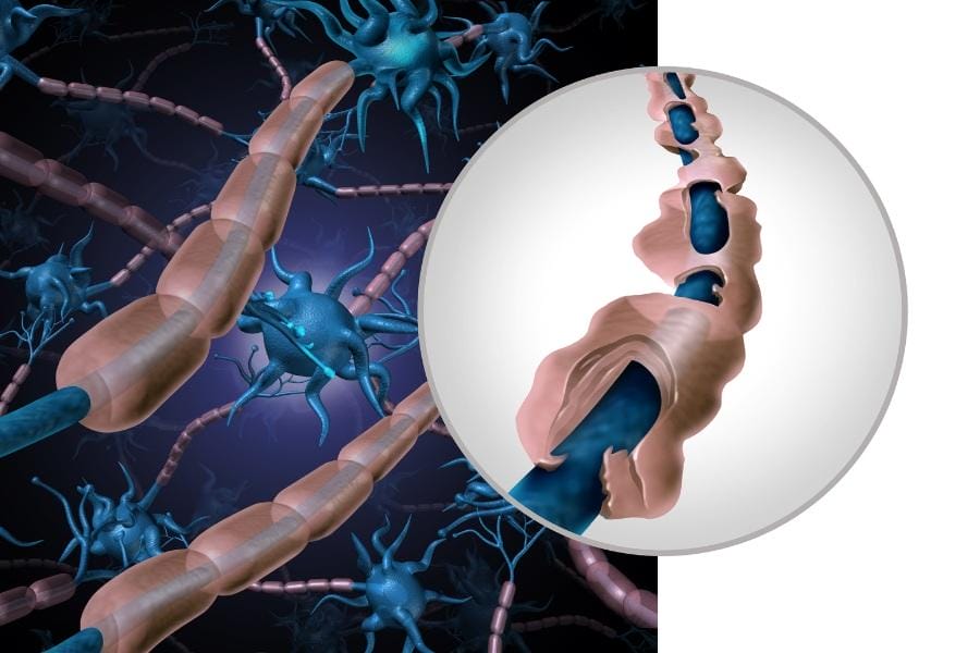 diagram of multiple sclerosis